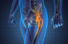 Асептичний некроз головки стегнової або таранної кістки, колінного суглоба: МКБ-10, стадії, лікування