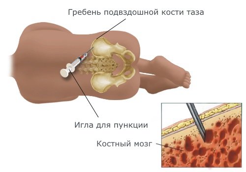 По каким признакам можно определить что у ребенка лейкоз и как лечат данную патологию