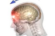 Класифікація черепно-мозкових травм, їх симптоми та лікування