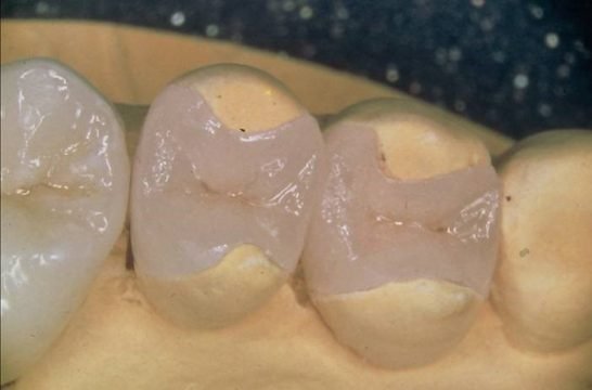 Що з себе представляє вкладка в зуб і її відмінність від пломб