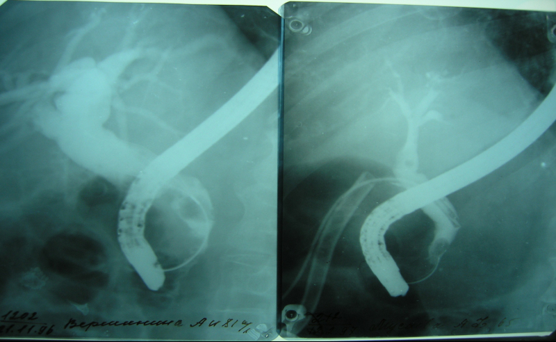chto takoe kholedokh, ego bolezni i lechenie171