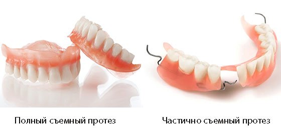 Що таке знімний акриловий зубний протез