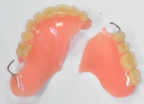 Що таке знімний акриловий зубний протез