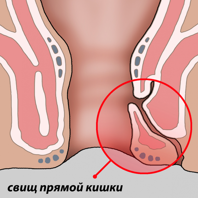 chto takoe svishh pryamojj kishki: simptomy, issechenie, lechenie bez operacii262