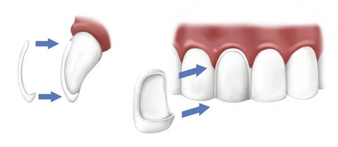 Що таке вініри для зубів і які краще