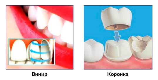 Що таке вініри для зубів і які краще