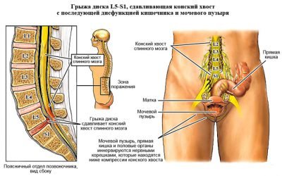 Дорзальна грижа міжхребцевого диску поперекового (l5-s1), шийного (C5-C6), грудного відділів, лікування