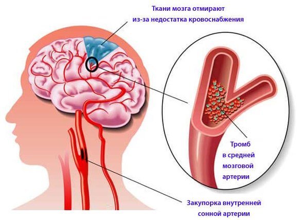Сосуды головного мозга — симптомы и лечение, какие бывают заболевания мозга