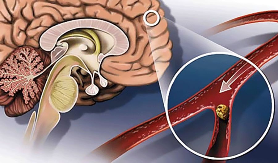 Сосуды головного мозга — симптомы и лечение, какие бывают заболевания мозга
