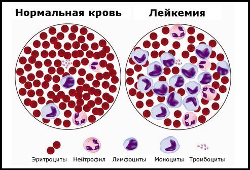 По каким признакам можно определить что у ребенка лейкоз и как лечат данную патологию