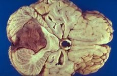 Епендимома головного та спинного мозку: види, симптоми, лікування, прогноз виживання