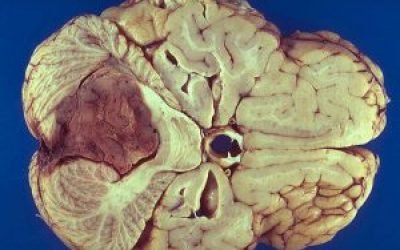 Епендимома головного та спинного мозку: види, симптоми, лікування, прогноз виживання