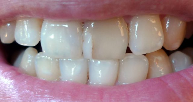Естетична реставрація передніх зубів