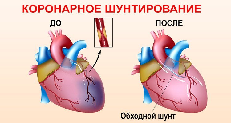 Поставили шунты. Шунт при инфаркте миокарда. Коронарное шунтирование сосудов сердца. Операция коронарное шунтирование сосудов сердца. Шунтирование коронарных артерий схема.