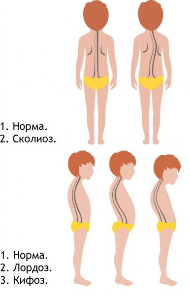 fizicheskie uprazhneniya dlya ispravleniya narushenijj osanki u detejj159