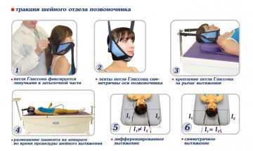 gryzha shejjnogo otdela pozvonochnika: simptomy, lechenie, foto, priznaki, kak izbavitsya228