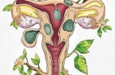 Інтерстиціальна форма міоми матки і вагітність, причини і симптоми, діагностика і лікування