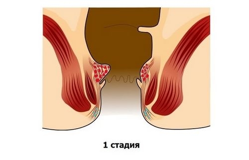 Як повністю вилікувати геморой без операції Як повністю вилікувати геморой без операції