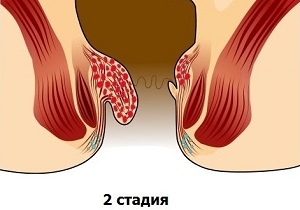 Як повністю вилікувати геморой без операції Як повністю вилікувати геморой без операції