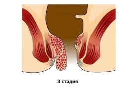 Як повністю вилікувати геморой без операції Як повністю вилікувати геморой без операції