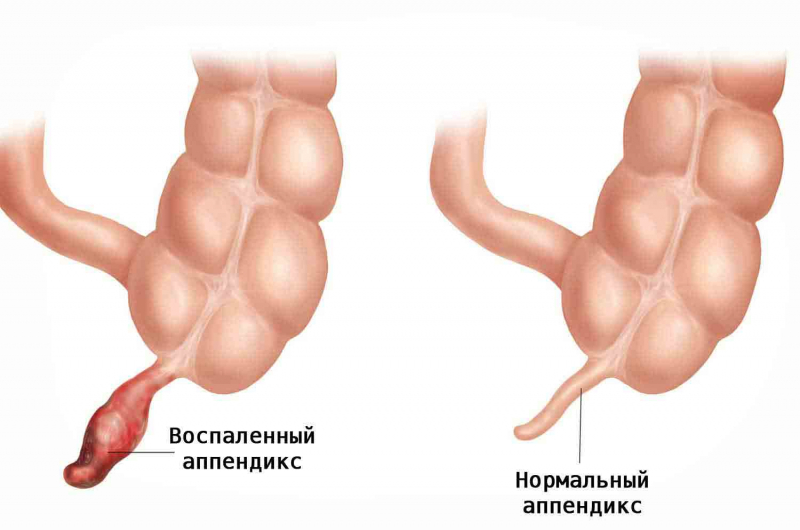 kak proiskhodit udalenie appendicita: vidy procedur, vosstanovlenie posle operacii206