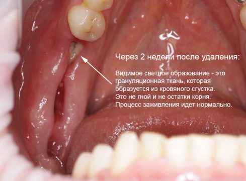 Як зняти набряк якщо опухла десна після видалення зуба