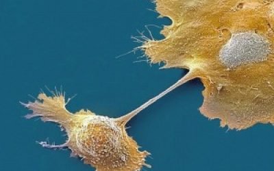 Як виявити рак шийки матки: аналізи, онкомаркери, УЗД скринінг, ознаки і симптоми