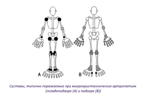 khondrokalcinoz psevdopodagra kolennogo sustava ili reber: simptomy, lechenie11