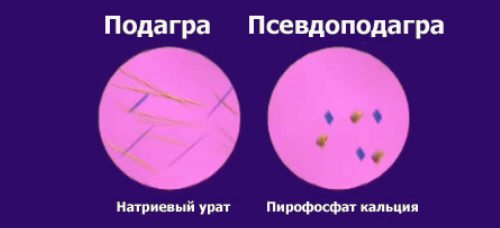 khondrokalcinoz psevdopodagra kolennogo sustava ili reber: simptomy, lechenie7
