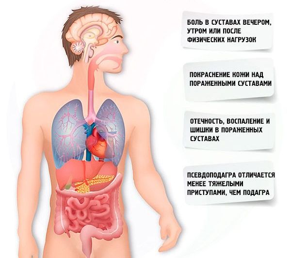 khondrokalcinoz psevdopodagra kolennogo sustava ili reber: simptomy, lechenie9