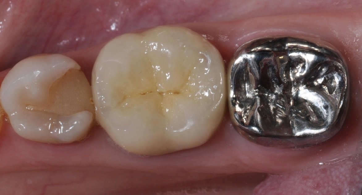Коронки на жувальні зуби: які краще і в чому особливості?