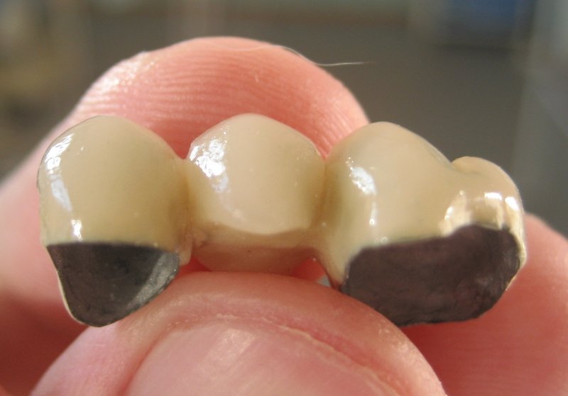 Коронки на жувальні зуби: які краще і в чому особливості?