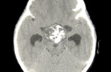 Краниофарингиома головного мозку у дітей: симптоми, лікування, видалення і прогноз після операції