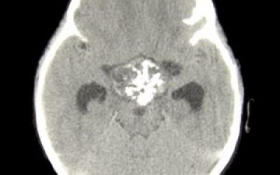 Краниофарингиома головного мозку у дітей: симптоми, лікування, видалення і прогноз після операції