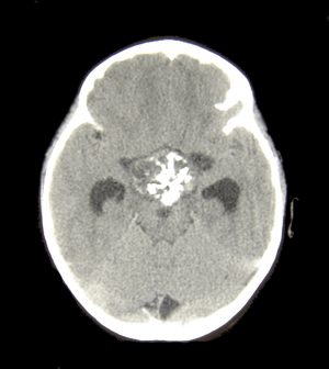 kraniofaringioma golovnogo mozga u detejj: simptomy, lechenie, udalenie i prognoz posle operacii194