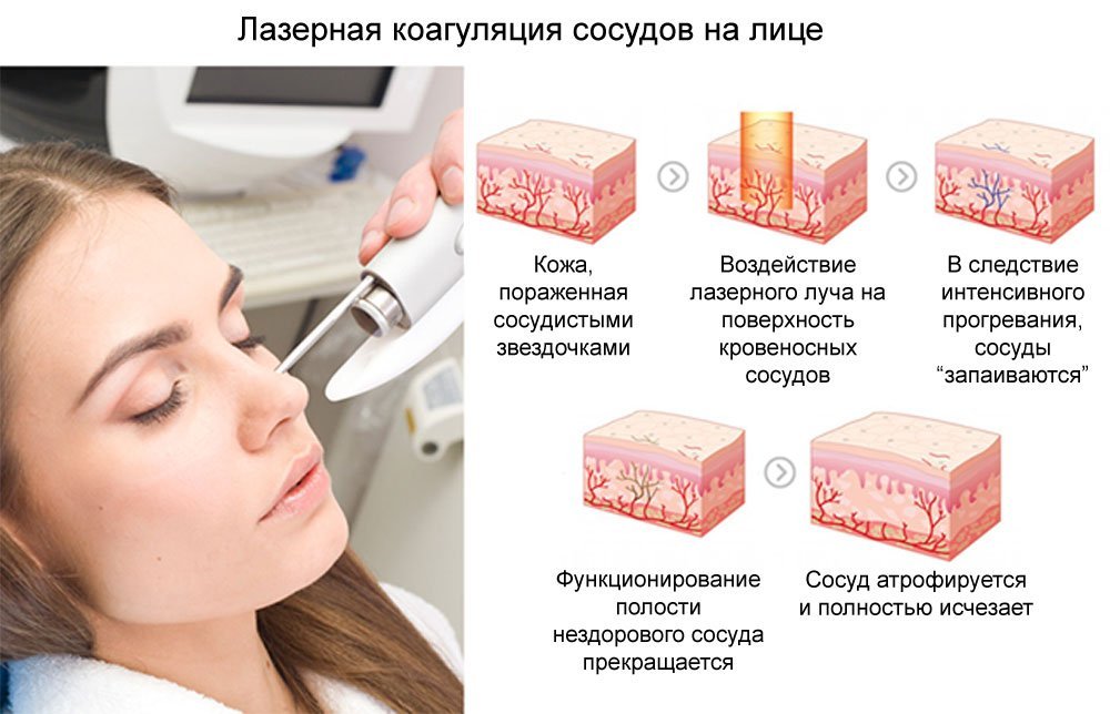 Фото Лечение Сосудов На Лице Отзывы
