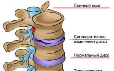 Лікувальна гімнастика Шишонина при шийному, грудному або поперековому остеохондрозі: відео