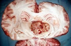 Медулобластома хробака мозочка у дітей і дорослих: прогноз, фото, причини, ускладнення та лікування