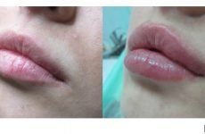 Мезонити в губи: відгуки, техніка введення, процедура, фото до і після, ціна