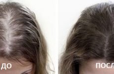 Мезотерапія волосистої частини голови (волосся): показання, протипоказання, техніка, ускладнення, побічні ефекти, відгуки, ціна