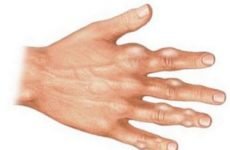 Мігруюча подагра на руках: ознаки, фото як виглядають тофуси, лікування ліками