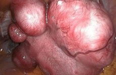 Міома матки: від чого з’являється і симптоми на ранніх стадіях, фото, види, лікування та профілактика