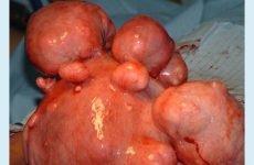 Множинна міома матки: причини і ознаки, фото, особливо при вагітності, лікування вузлів