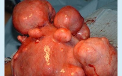 Множинна міома матки: причини і ознаки, фото, особливо при вагітності, лікування вузлів