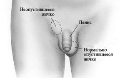 Операція орхипексия (орхидопексия) у дітей і дорослих: показання, методи проведення, ускладнення