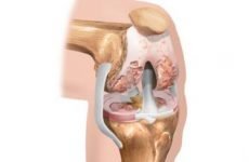 Остеохондропатия колінного, кульшового, гомілковостопного суглоба та кісток: код за МКХ-10, лікування у дітей