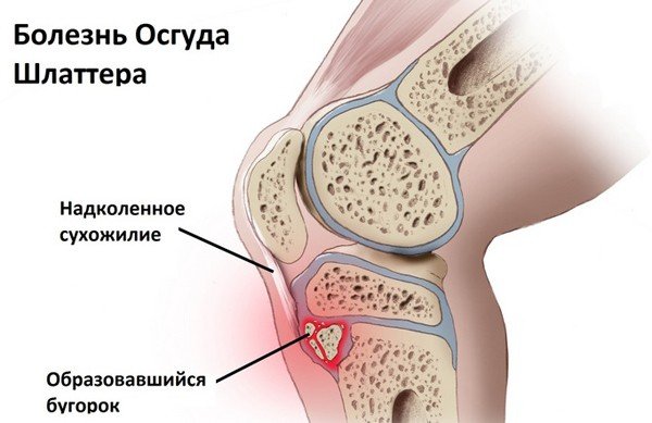 osteokhondropatiya u detejj: mkb 10, klassifikaciya, lechenie, stadii, ehtiologiya i patogenez, prichiny101