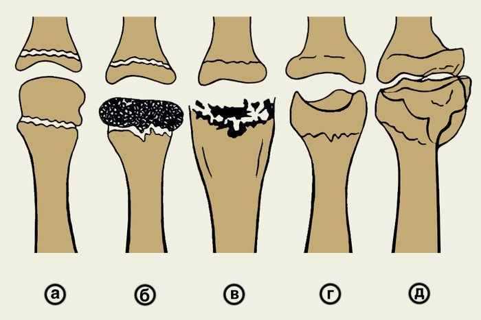 osteokhondropatiya u detejj: mkb 10, klassifikaciya, lechenie, stadii, ehtiologiya i patogenez, prichiny102