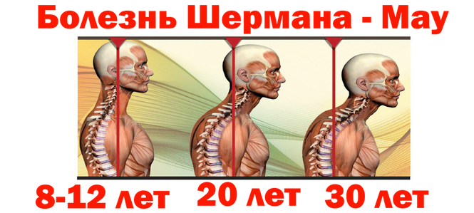 osteokhondropatiya u detejj: mkb 10, klassifikaciya, lechenie, stadii, ehtiologiya i patogenez, prichiny103