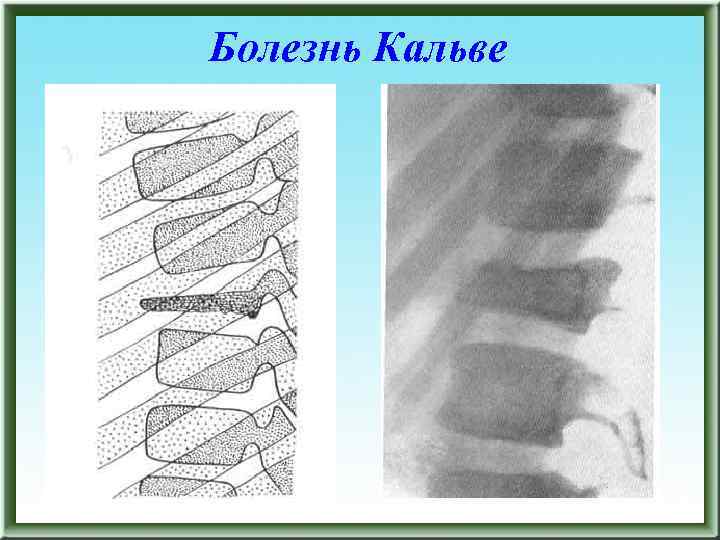 osteokhondropatiya u detejj: mkb 10, klassifikaciya, lechenie, stadii, ehtiologiya i patogenez, prichiny104